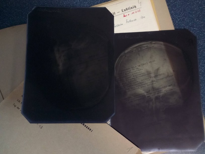 Zdjęcie rentgenowskie wykonane w Lublińcu podczas pneumoencefalografii /Archiwum Państwowe w Katowicach  /materiały prasowe