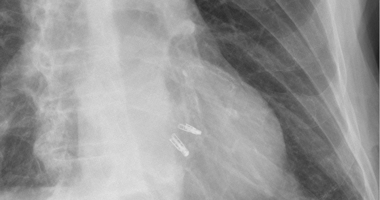 Zdjęcie RTG przedstawiające dwa urządzenia MitraClips umieszczone w sercu /Fot. Hellerhoff /Wikipedia