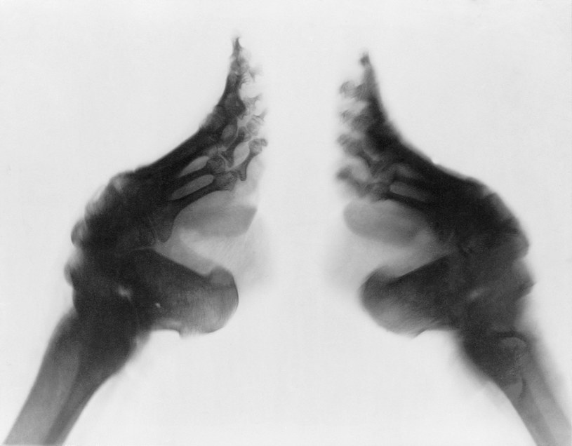 Zdjęcie RTG ukazuje ogrom deformacji w krępowanych stopach /Courtesy Everett Collection