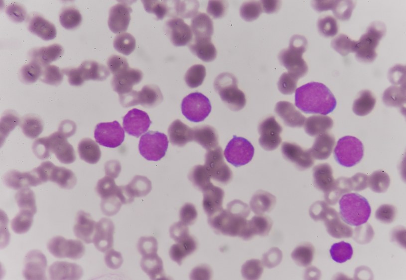 Zdjęcie spod mikroskopu krwi pacjenta cierpiącego na białaczkę /123RF/PICSEL