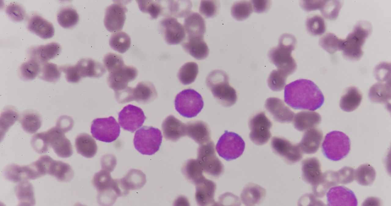 Zdjęcie spod mikroskopu krwi pacjenta cierpiącego na białaczkę /123RF/PICSEL