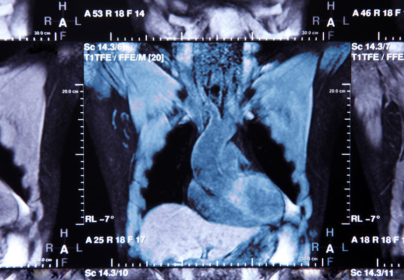 Zdjęcie TK (tomografii komputerowej) tętnic wieńcowych /123RF/PICSEL