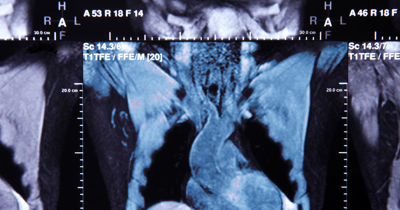 Zdjęcie TK (tomografii komputerowej) tętnic wieńcowych /123RF/PICSEL