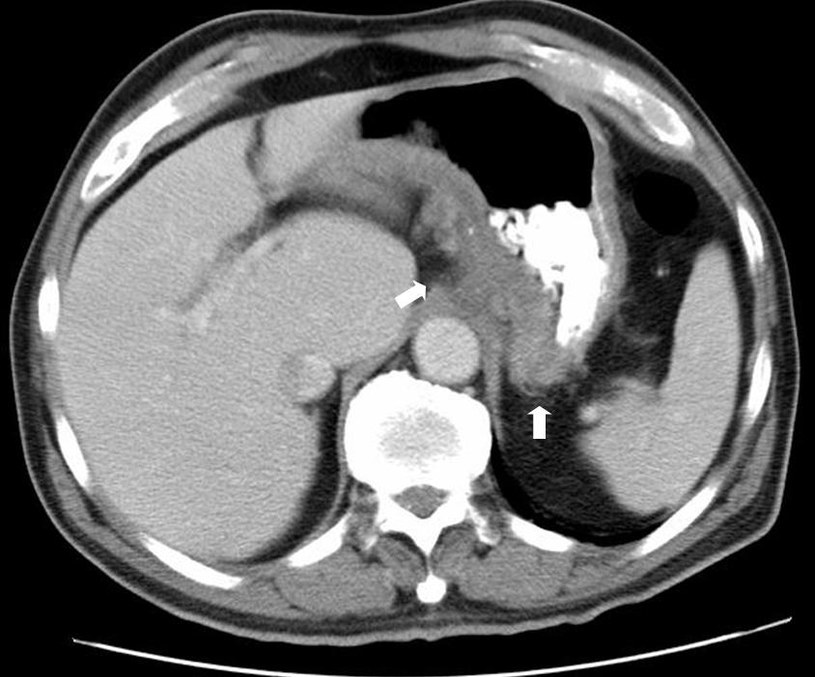 Zdjęcie tomografii komputerowej ukazujące zajęcie przez chorobę Crohna dna żołądka /.