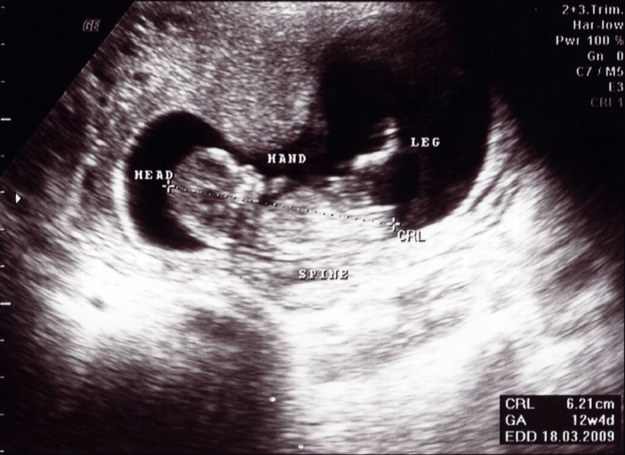 Zdjęcie USG 12. tygodnia ciąży. /123RF/PICSEL