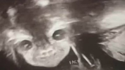 Zdjęcie USG jej dziecka przeraziło nawet lekarzy