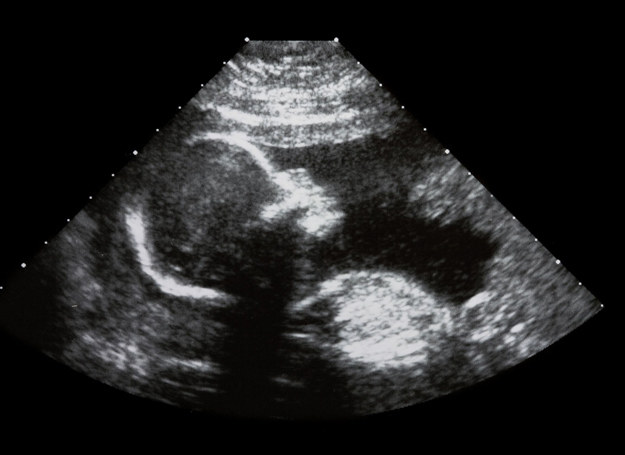 Zdjęcie USG w 4 miesiącu ciąży. /123RF/PICSEL