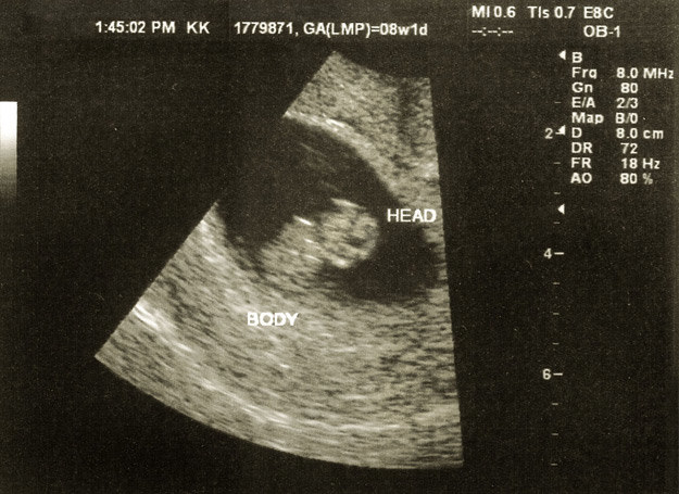 Zdjęcie USG w ósmym tygodniu ciąży. /123RF/PICSEL