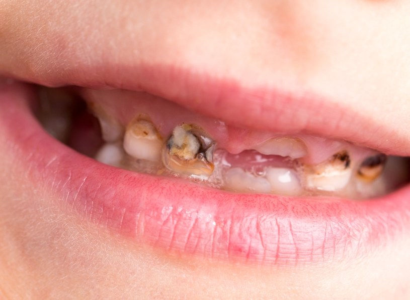 Zęby polskich dzieci są w bardzo złym stanie. /123RF/PICSEL