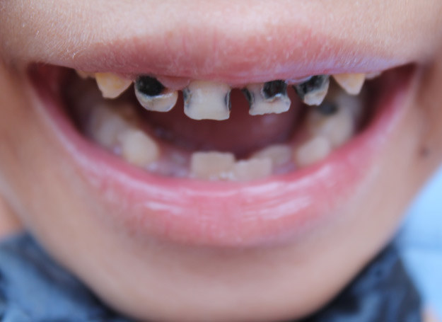 Zęby twojego dziecka też będą tak wyglądać, jeśli... /123RF/PICSEL