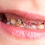 Zepsute zęby ma ponad 85 proc. 6-latków i 95 proc. 18-latków w Polsce