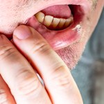 Zespół pieczenia jamy ustnej. Co może za nim stać? 