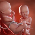 Zespół podkradania - połączenie pomiędzy bliźniętami, które może mieć tragiczne skutki