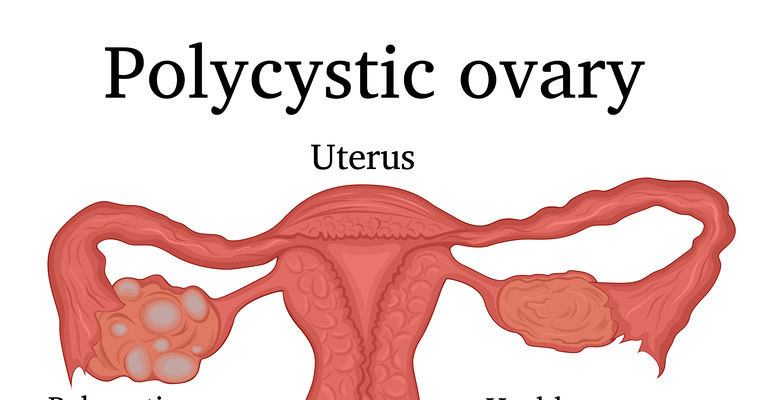 Zespół policystycznych jajników /&copy;123RF/PICSEL
