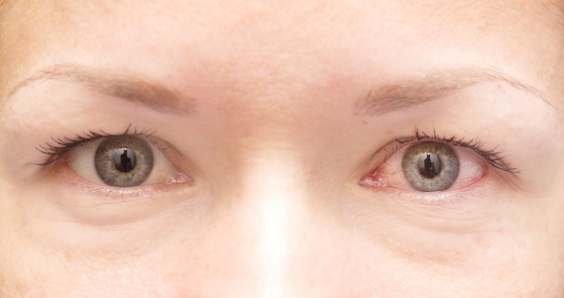 Zespół suchego oka dotyka coraz więcej osób /123RF/PICSEL