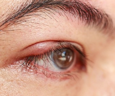 Zespół suchego oka: Jak sobie z nim radzić?