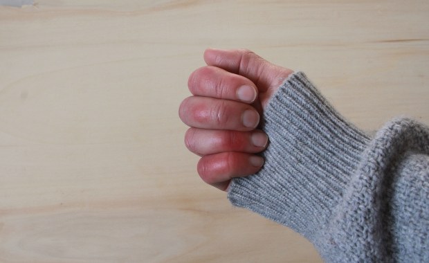 Zima atakuje skórę. Czas na odmrożenia, ale i oparzenia