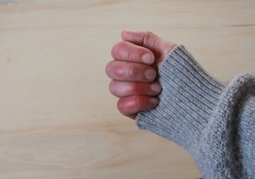 Zima atakuje skórę. Czas na odmrożenia, ale i oparzenia