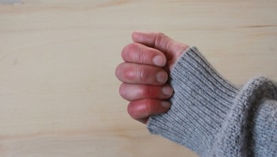 Zima atakuje skórę. Czas na odmrożenia, ale i oparzenia