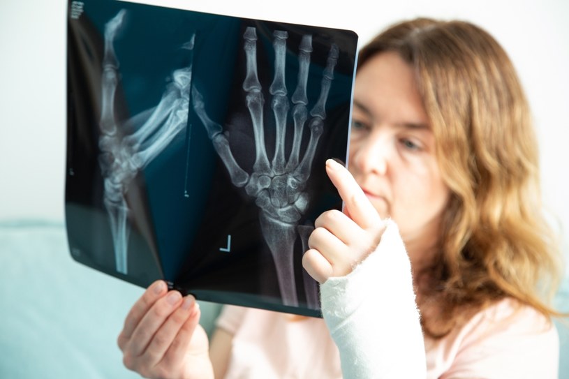 Złamania są częste u osób z osteoporozą i niedoborami. Kość osób starszych nie zawsze wraca do pełnej sprawności /123RF/PICSEL