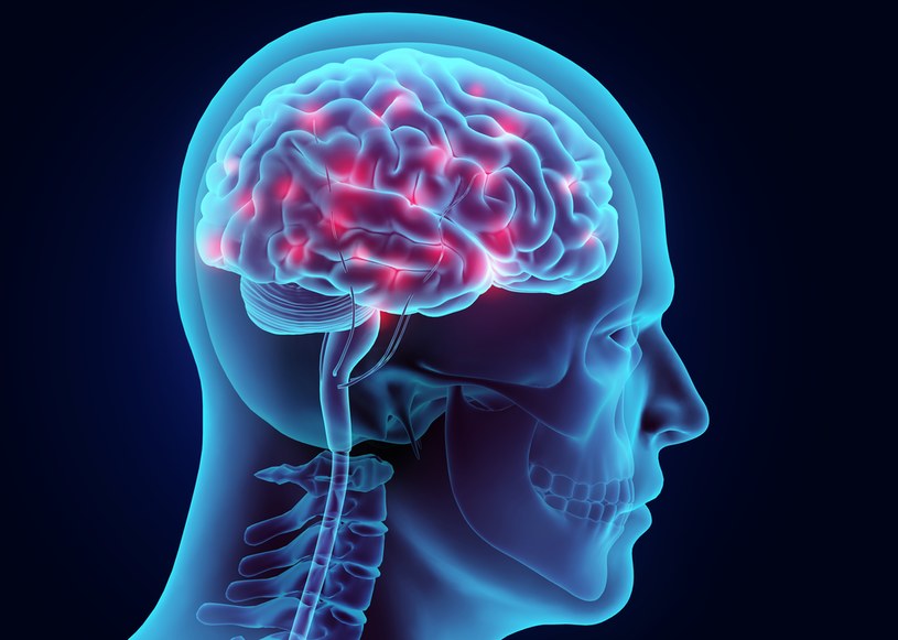 Złogi pojawiające się w mózgu mogą powodować problemy ze słuchem, omamy wzrokowe, a także zmiany w zachowaniu /123RF/PICSEL