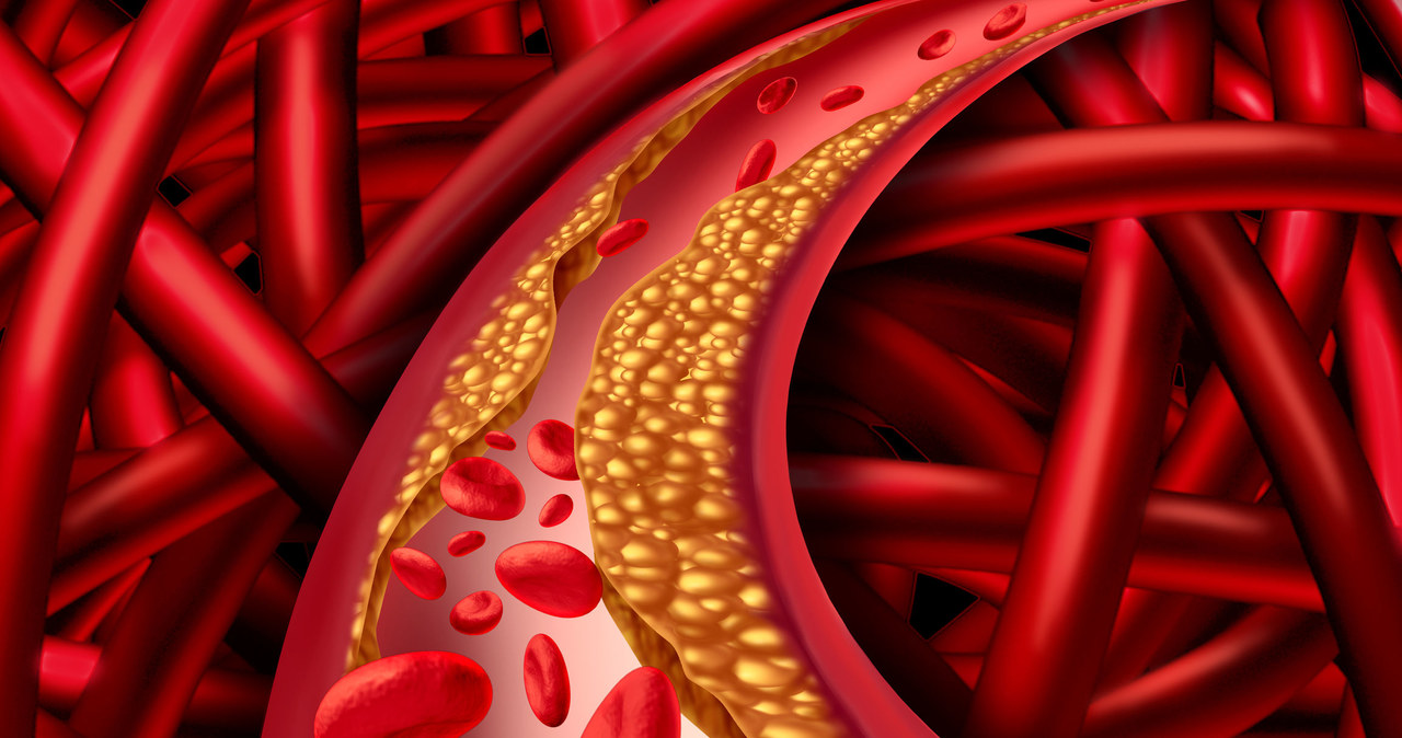 Zły cholesterol zapycha żyły prowadząc do wielu chorób z miażdżycą i zawałem na czele /123RF/PICSEL