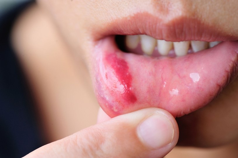 Zmian w obrębie jamy ustnej lepiej nie bagatelizować! /123RF/PICSEL
