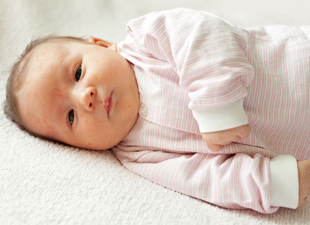 Zmiany na skórze prawdopodobnie wynikają z nieprawidłowej pracy gruczołów łojowych i działania hormonów, które niemowlę otrzymało od matki. /123RF/PICSEL