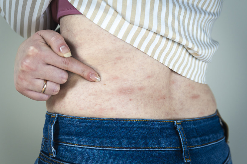 Zmiany skórne to częsty objaw alergii pokarmowej. Z czasem mogą się zaostrzać i powodować ból nie do zniesienia /123RF/PICSEL