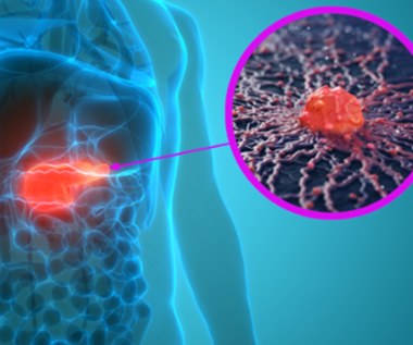 Znaleziono mechanizm, który wywołuje raka trzustki. Pomoże w leczeniu