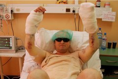 Żołnierz, któremu przeszczepiono obie ręce, rusza palcami