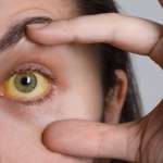 Żółtaczka w szpitalu wojewódzkim. Działania epidemiologiczne w toku