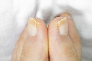 Żółte paznokcie to wstydliwy problem. Nie zawsze oznaczają tylko grzybicę!