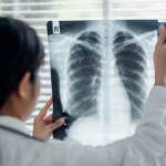 rak płuc metody leczenia Zostawia ślad we krwi na lata przed diagnozą raka płuca. Naukowcy wskazali konkretne zmiany