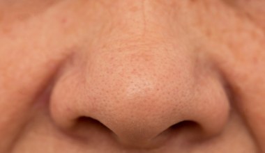 Zredukuj zaskórniki delikatnym serum z kwasem mlekowym. Jest lepsze od drogeryjnego