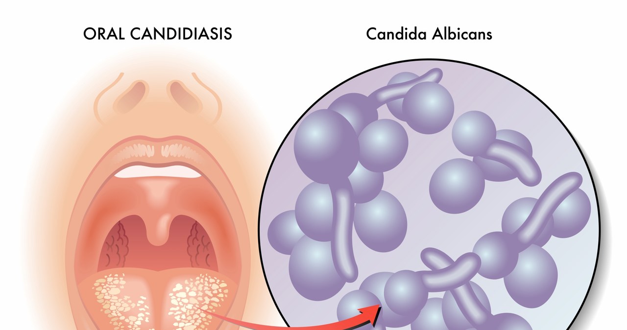 Źródłem infekcji jest Candida albicans /123RF/PICSEL