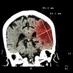 Związek COVID-19 z udarem mózgu nadal niejasny