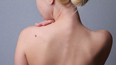 Zwracajmy uwagę na znamiona na skórze. Niektóre mogą być śmiertelnie niebezpieczne 